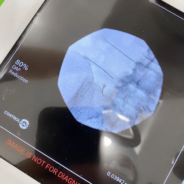 ControlRad's tweet photo. When using ControlRad Trace plus collimation, Hospital for Special Surgery in New York City reduced their radiation exposure by 80% during this interventional pain procedure. https://t.co/WiymsCInic #controlrad #radiationsafety #xraysafety https://t.co/8cRCopXutq