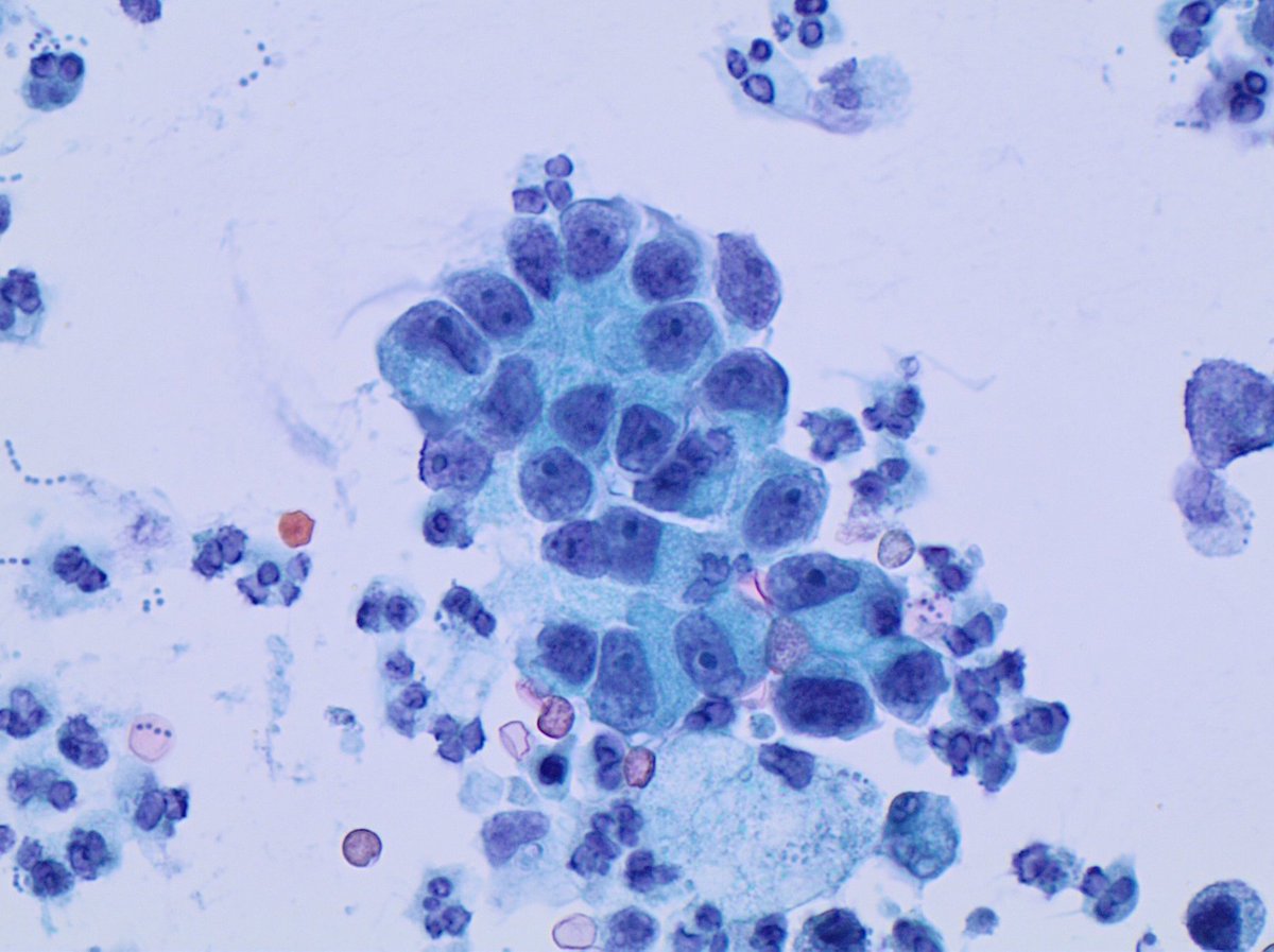 VarshaManuchaMD's tweet photo. #FluidsMonday
#UrineCytology
🌟Voided urine with metastatic prostate adenocarcinoma🌟
➡️Clustered or microacinar grouping
➡️Enlarged nuclei with smooth/thin nuclear border
➡️Well defined moderate cytoplasm
➡️One or more centrally-located prominent nucleoli
IHC -NKX3.1 https://t.co/TybwZT4JUm