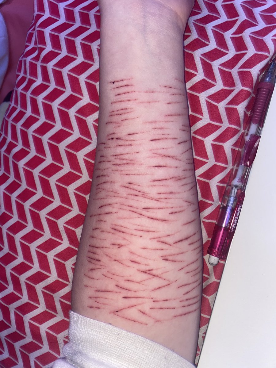 555angelcore555's tweet photo. its been maybe 15 hours and heres an update on em. https://t.co/jO27FrfEIG