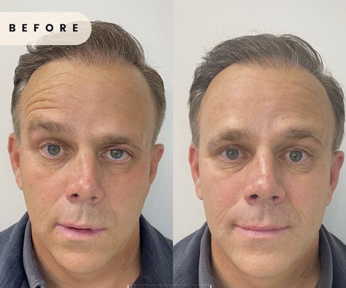 Did you know that neuromodulators like Botox/Dysport can be used to help relax & even out muscles that are tightened or overactive due to Bells Palsy or Facial Paralysis?

Photos are two weeks apart 💉