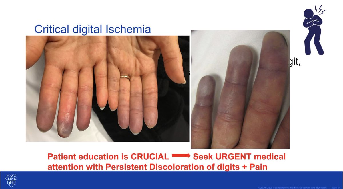 Sharing a few slides from my #Raynauds talk earlier today with 🔑 takeaways #MedEd @MayoClinic #MayoSTIM2022 #MayoClinicRheumatology #RheumTwitter