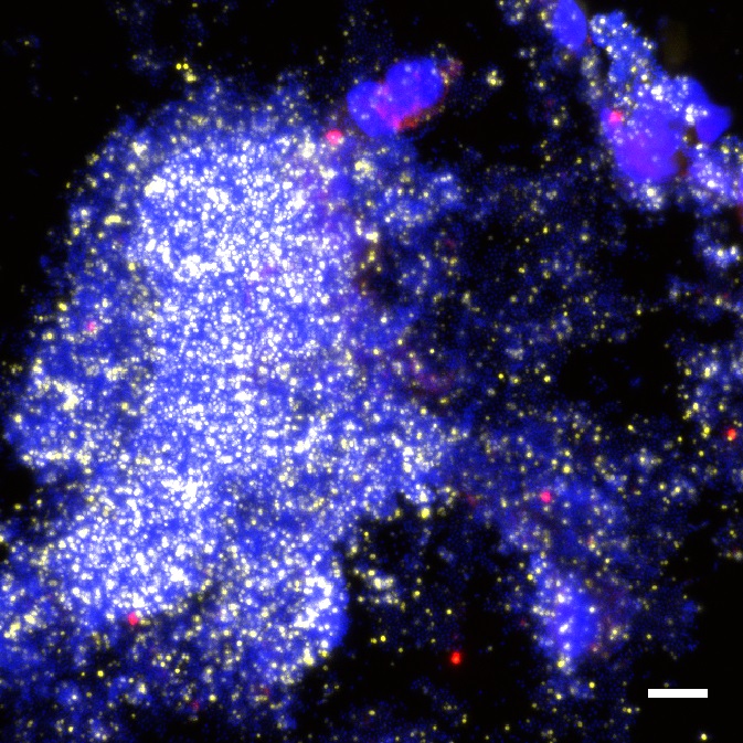 MenziesResearch's tweet photo. NEW PAPER | @MenziesResearch &amp; @telethonkids found a breakthrough in understanding recurrent chest infections in children, helping to direct investigations into treatments so fewer will progress to experiencing severe lung disease. @LancetMicrobe 
https://t.co/PzW1VqRLqO https://t.co/pVsr8SxbO7