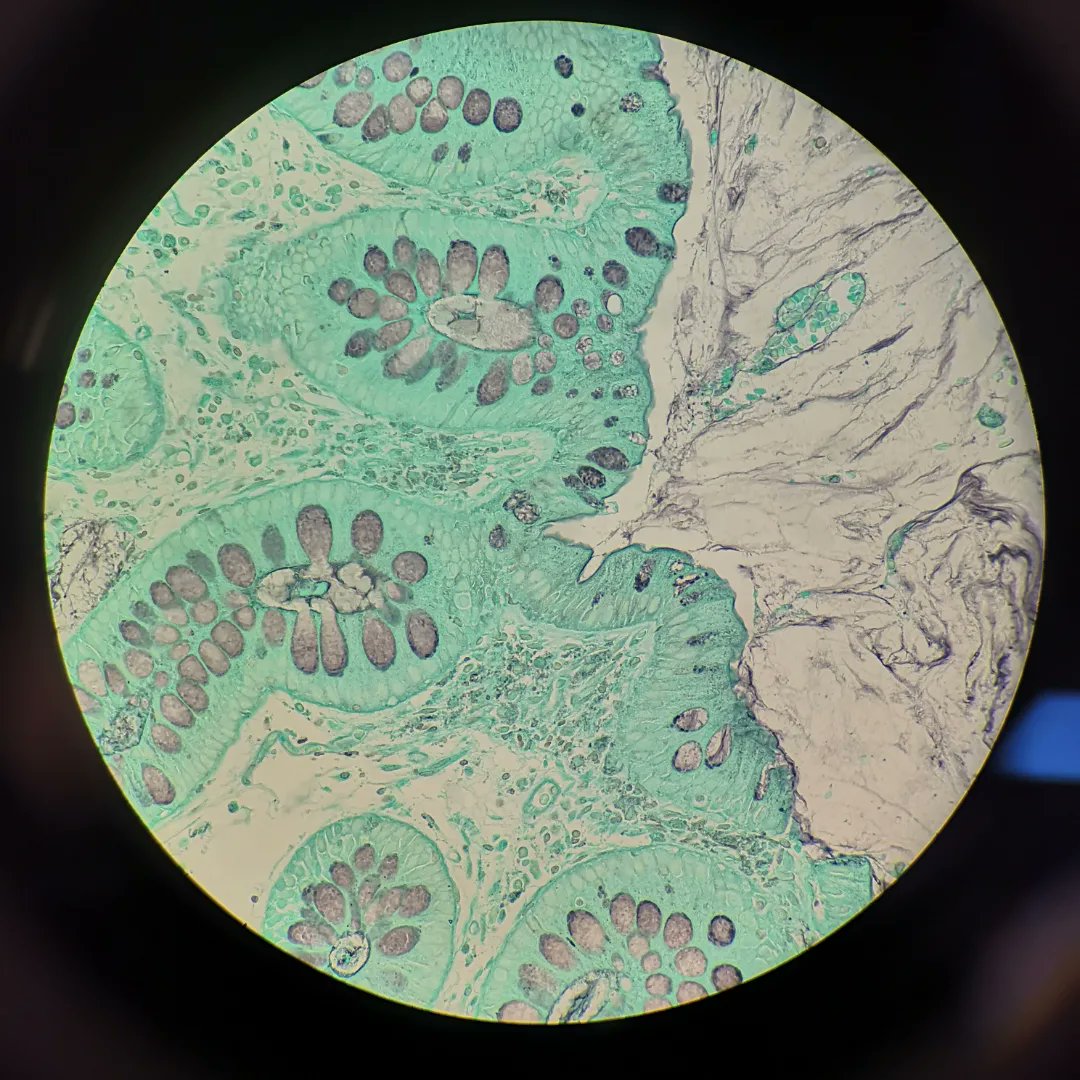 techingonsci's tweet image. Grocott, ZN and PAS stains on colon 😍

#MicroscopeArt #MicroscopePhoto #Science #Pathology