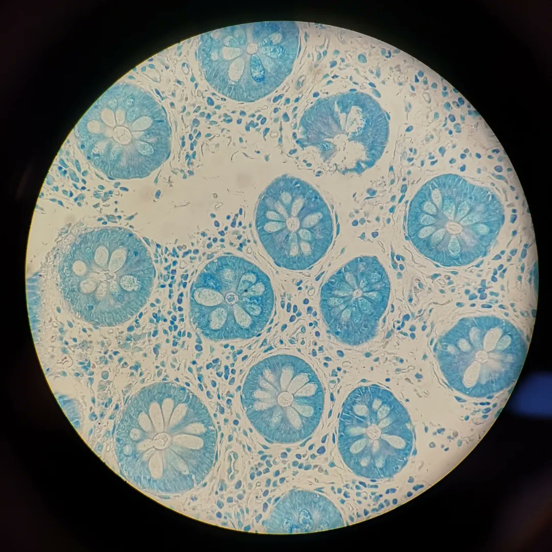 techingonsci's tweet image. Grocott, ZN and PAS stains on colon 😍

#MicroscopeArt #MicroscopePhoto #Science #Pathology
