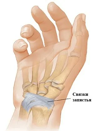 Связки запястного сустава. Повреждение связочно капсульного аппарата кисти. Разрыв связок лучезапястного сустава. Растяжение связки большого пальца. Связки запястного сустава. Повреждение связочно капсульного аппарата кисти. Разрыв связок лучезапястного сустава.