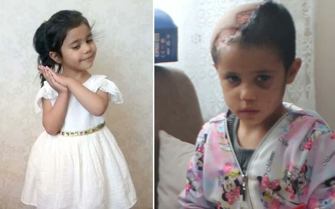 Gaziantep'te pitbullun sald�rd��� Asiye Ate�'in son hali