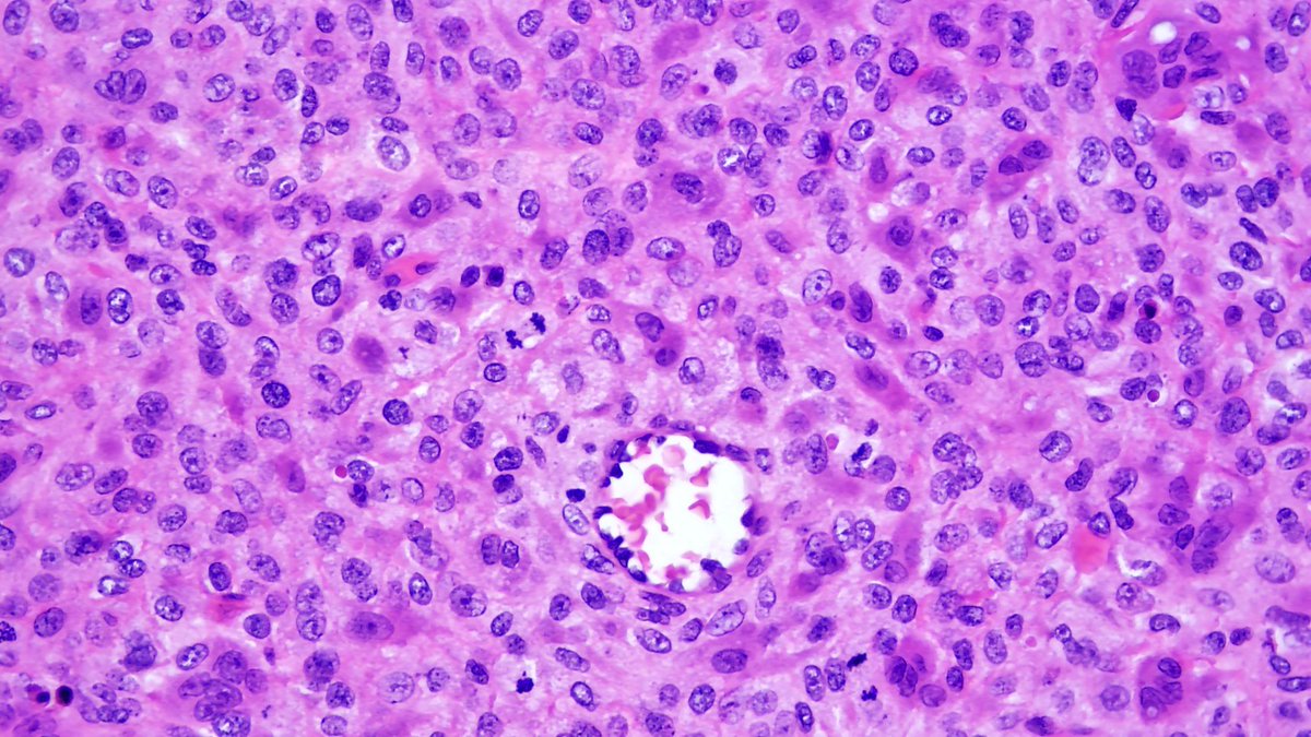 JDCo2pock's tweet photo. 58F lateral femoral condyle lesion - malignant giant cell tumor of bone with focal osteosarcomatous differentiation #BSTpath #PennPath https://t.co/DQqvmtU8g4