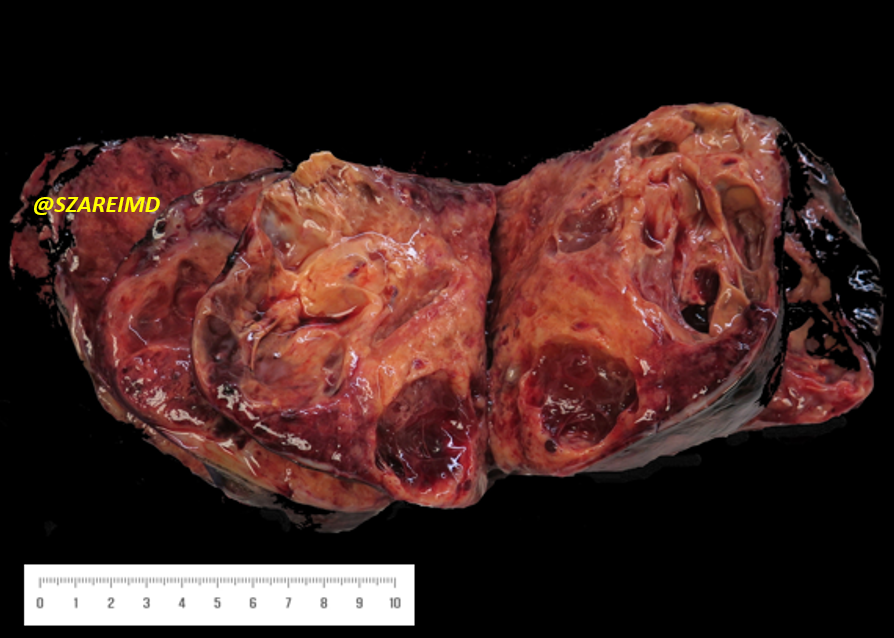 SZareiMD's tweet photo. 20s F, unilateral ovarian mass sent for frozen. What tumor marker do you expect to be elevated? #gynpath #pathtwitter https://t.co/UNNOzs2ZgQ