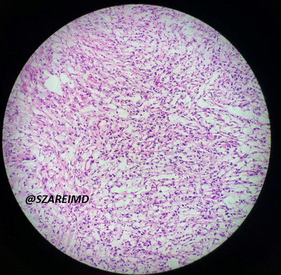 SZareiMD's tweet photo. 20s F, unilateral ovarian mass sent for frozen. What tumor marker do you expect to be elevated? #gynpath #pathtwitter https://t.co/UNNOzs2ZgQ