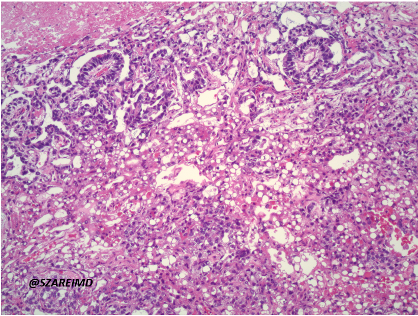 SZareiMD's tweet photo. 20s F, unilateral ovarian mass sent for frozen. What tumor marker do you expect to be elevated? #gynpath #pathtwitter https://t.co/UNNOzs2ZgQ