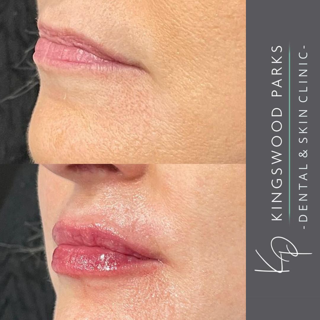 KPClinics's tweet photo. Close up of this beautiful transformation #lipfiller #lipenhancement #hullclinic #hullcity #skinclinic #liptreatment https://t.co/HRvZKxc2yC
