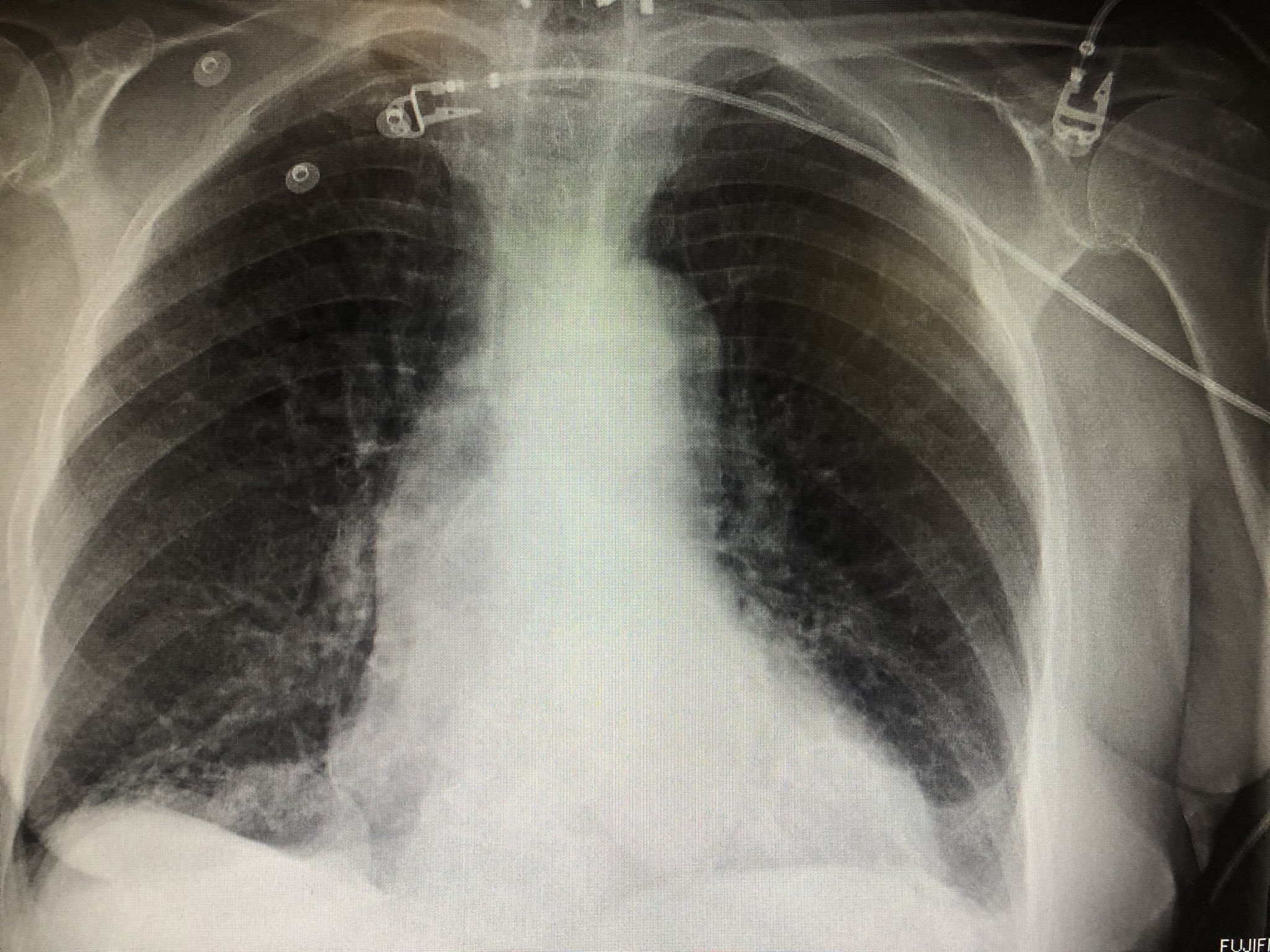 Atelectasis Chest X Ray
