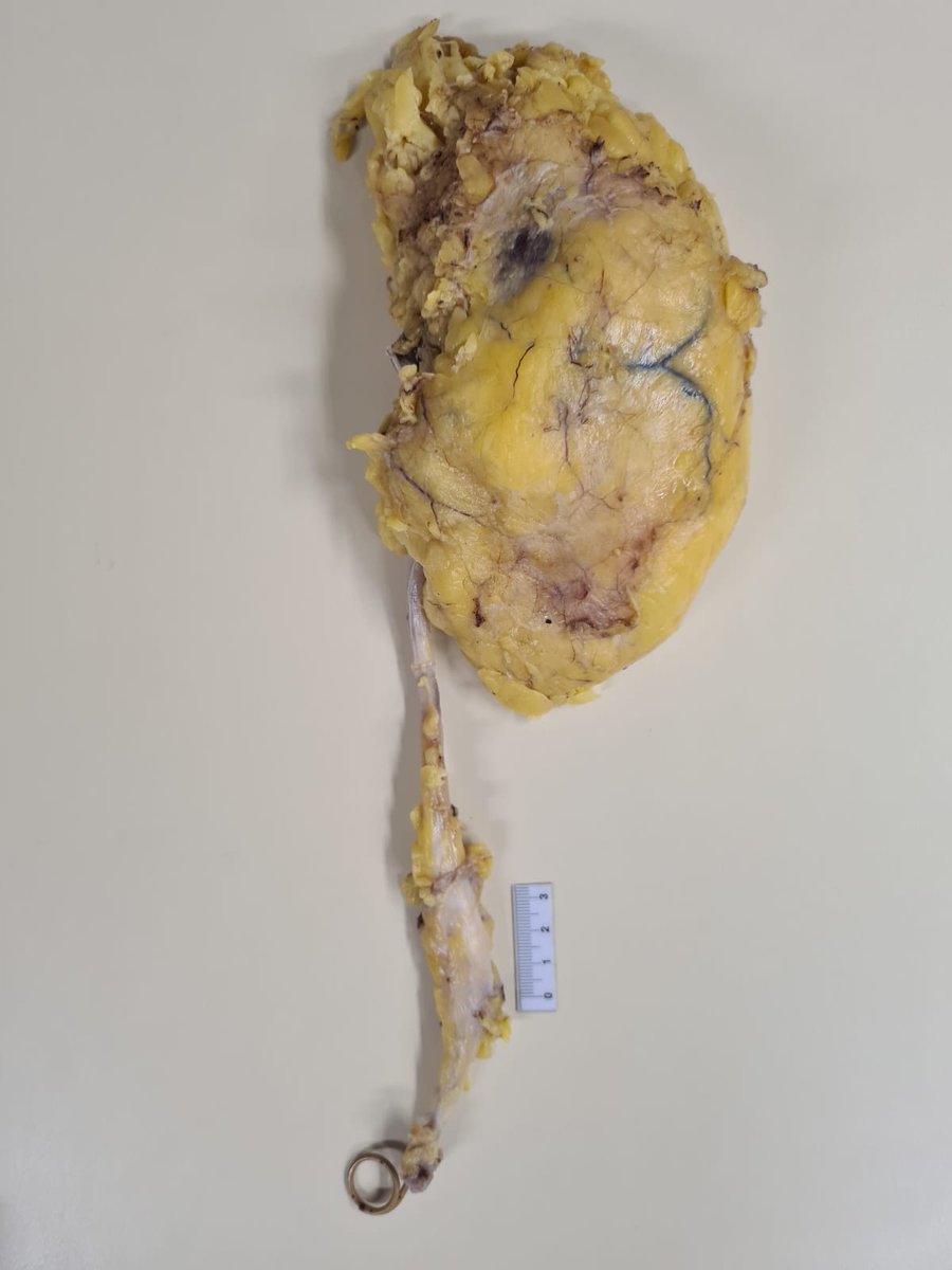 Francisco Dávila (@franciscodvila) on Twitter photo Laparoscopic radical Nephroureterectomy with bladder cuff for treatment of ureteral tumor thanks <a href="/AntonioGorgen/">Antônio Gorgen</a>, <a href="/renancabral/">Renan Desimon Cabral 🇧🇷</a> photos taken by pathology @SIMONEMARCIADO2 Laparoscopic radical Nephroureterectomy with bladder cuff for treatment of ureteral tumor thanks <a href="/AntonioGorgen/">Antônio Gorgen</a>, <a href="/renancabral/">Renan Desimon Cabral 🇧🇷</a> photos taken by pathology @SIMONEMARCIADO2