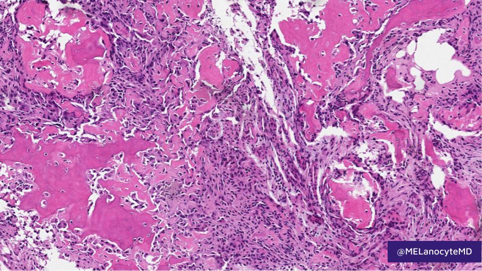 MELanocyteMD's tweet photo. Osteoid osteoma/Osteoblastoma:
📏 OO<2cm/OB≥2cm
👩‍⚕️ Most <25 y/o, ♂️>♀️ (2:1)
🦴 Lytic, w/ target sign
🔬 Woven bone lined by plump osteoblasts &amp; scattered giant cells 
🔬 Loose fibrovascular stroma
🧬 Rearrangements: FOS > FOSB

➡️ Learn more at: https://t.co/7eFygtRDMB
#bstpath https://t.co/siRJ13naJS