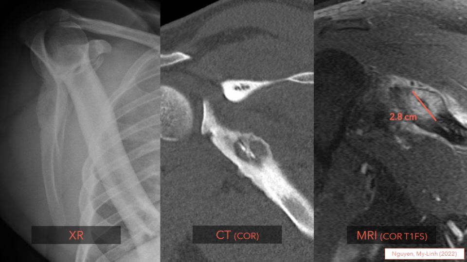 Osteoid osteoma/Osteoblastoma:
📏 OO<2cm/OB≥2cm
👩‍⚕️ Most <25 y/o, ♂️>♀️ (2:1)
🦴 Lytic, w/ target sign
🔬 Woven bone lined by plump osteoblasts &amp; scattered giant cells 
🔬 Loose fibrovascular stroma
🧬 Rearrangements: FOS > FOSB

➡️ Learn more at: kikoxp.com/posts/9241
#bstpath