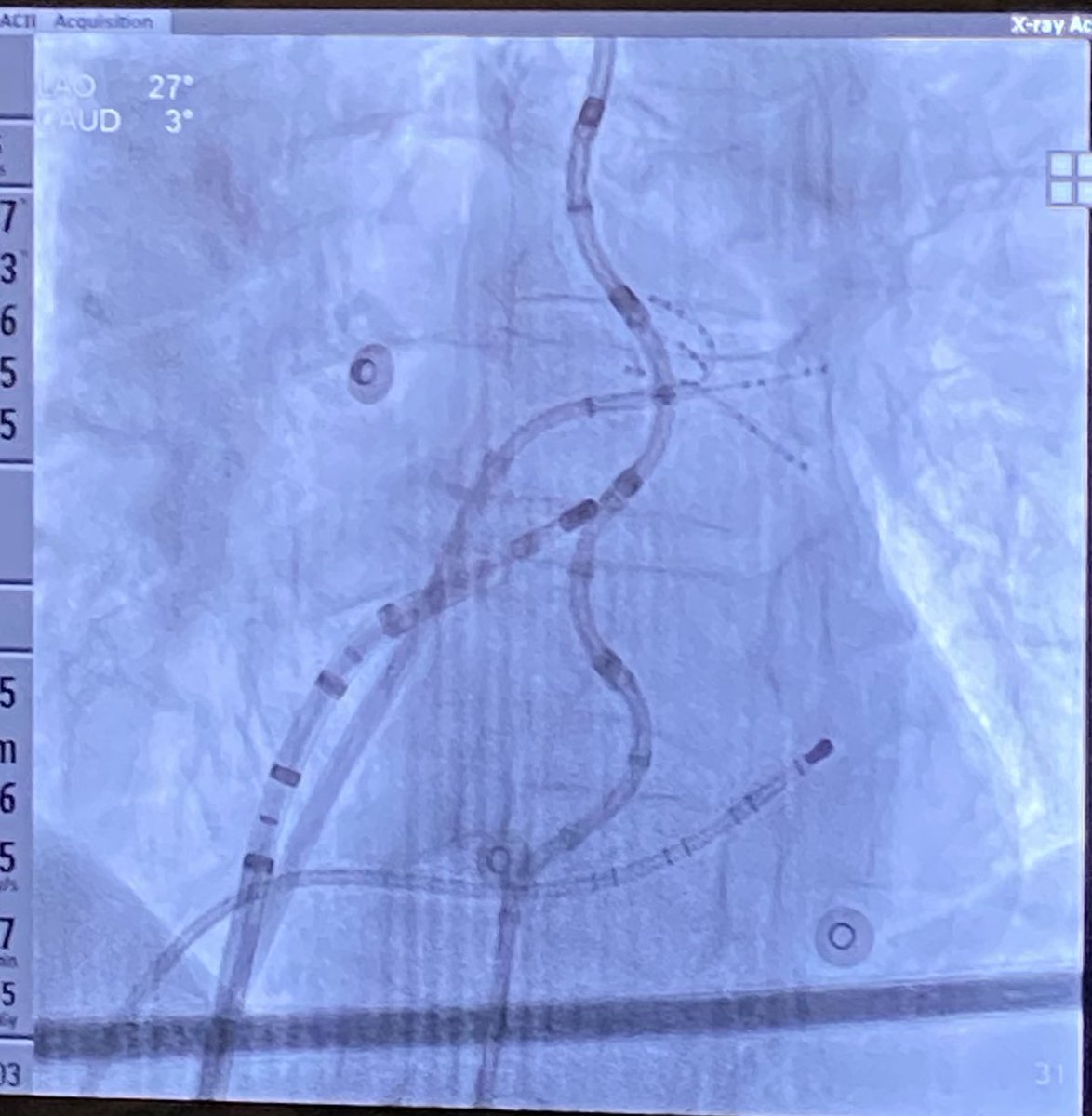 CarinaHardy4's tweet photo. @Hapa_EP @MDTolgaAksu @javadm20 @Ed_Gerst @MRobinsonEP @MBarakatMD @narrowQRS @EPWoodsShop @Maeskander @EF_Cardiaca @DRosenth_ @finnakerstrom @MicheleB_MD @jeffrey_vinocur @jfreeMD @NashwaAbdulsal1 @SchakrabartiEP @JonHsuMD Great work! I have used this technique to isolate the PW routinely because of the epi connections!  
I usually make a line away from the eso to protect it @finnakerstrom ! 
Visualization of the eso is done with #CIRCA 3D thermometer https://t.co/bE4fQ1kl35