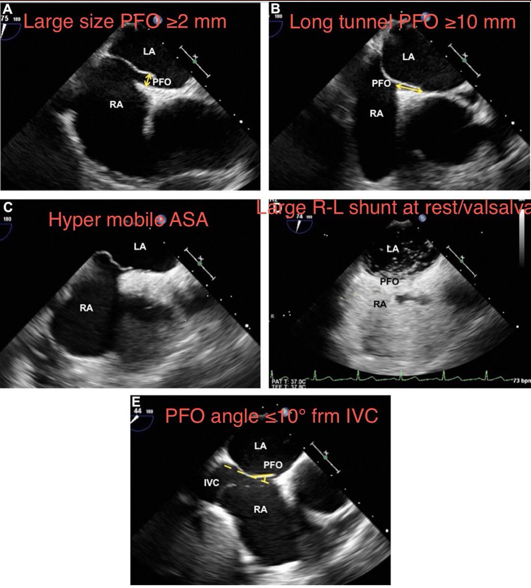 <a href="/LilyLeiZhang1/">Lily Zhang</a> <a href="/EGarciaSayan/">Enrique Garcia-Sayan, MD, FACC, FASE</a> <a href="/JournalASEcho/">JASE</a> <a href="/hahn_rt/">RTHahnMD</a> <a href="/edwardagill/">Edward Gill</a> <a href="/ASE360/">American Society of Echocardiography</a> PFO risk score for 
cryptogenic stroke(￼if score ≥2)
each worth 1 pt:
￼large-size PFO ≥2 mm 
￼long-tunnel PFO ≥10 mm ASA
￼hypermobile ASA
￼prominent eustachian valve/Chiari's network
￼large R-L shunt at rest/Valsalva 
￼PFO ≤10° frm IVC #ASEchoJC bit.ly/3Hm1RJ3