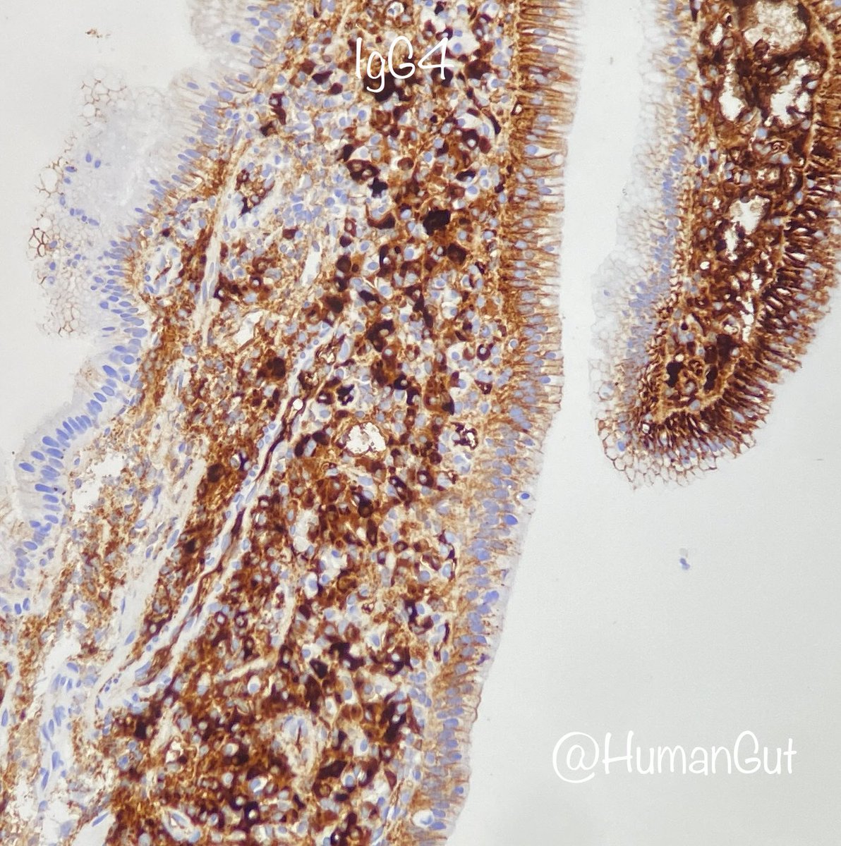 IgG4-related autoimmune pancreatitis