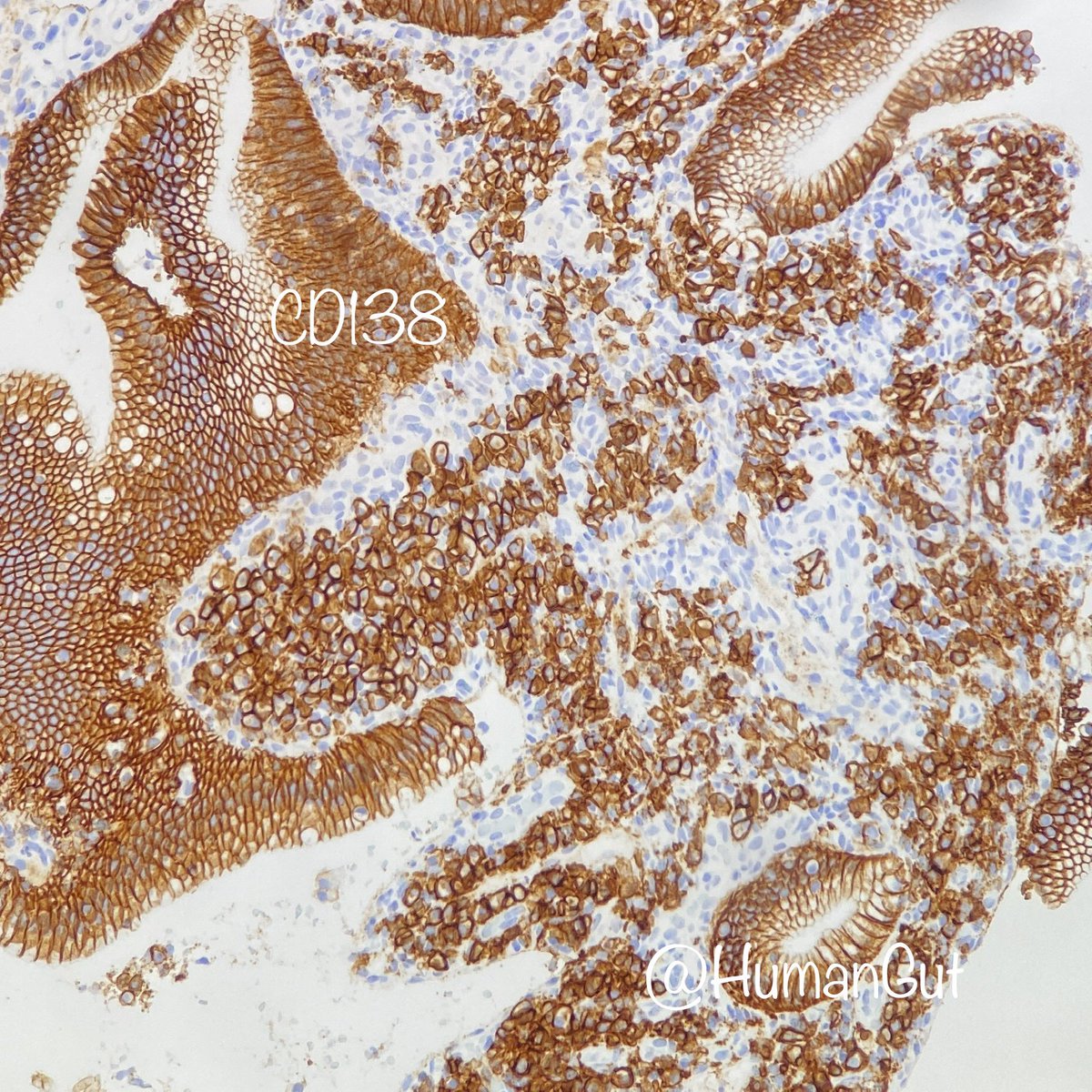 HumanGut's tweet photo. IgG4-related autoimmune pancreatitis https://t.co/BlrTJQ2Wd1