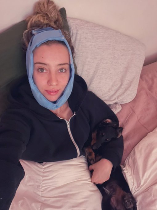 By popular request here&rsquo;s me post wisdom teeth removal in the jaw bra 😂  Also miss FreyFrey took me too