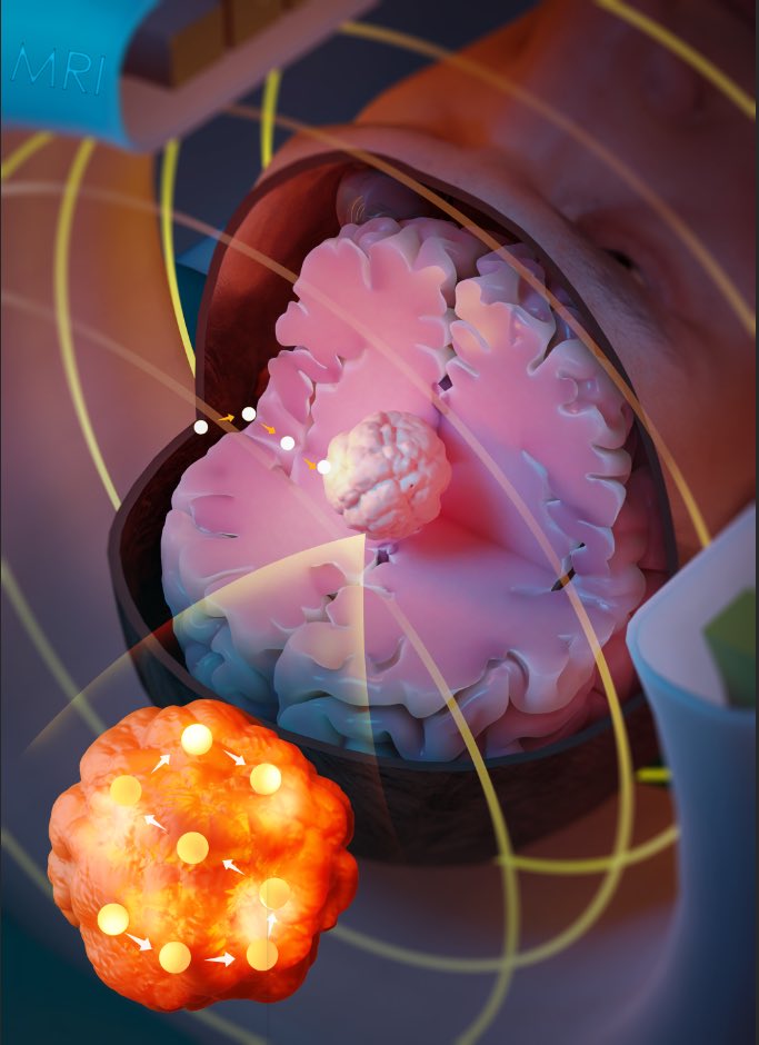 Mark Lythgoe (@marklythgoe) on Twitter photo Our new paper in Advanced Science: MRI Guides Magnetic Seed to Destroy Cancer. onlinelibrary.wiley.com/doi/10.1002/ad… thanks to <a href="/RebeccaRBaker29/">Rebecca Rose Baker</a> <a href="/ruidiyu/">Yichao Yu</a> @Dee_Kay_Jay <a href="/EmbertonMark/">Mark Emberton</a> <a href="/RosetreesT/">Rosetrees Trust</a> <a href="/BrainTumourOrg/">The Brain Tumour Charity</a> #MRI <a href="/CABI_UCL/">CABI</a> <a href="/uclnews/">UCL News</a> <a href="/uclmedsci/">UCL Faculty of Medical Sciences</a> <a href="/Health_Eng/">UCL Institute of Healthcare Engineering</a> <a href="/uclcancer/">UCL Cancer Institute</a> <a href="/HealthUCL/">UCL Health</a> @AdvSciNews Our new paper in Advanced Science: MRI Guides Magnetic Seed to Destroy Cancer. onlinelibrary.wiley.com/doi/10.1002/ad… thanks to <a href="/RebeccaRBaker29/">Rebecca Rose Baker</a> <a href="/ruidiyu/">Yichao Yu</a> @Dee_Kay_Jay <a href="/EmbertonMark/">Mark Emberton</a> <a href="/RosetreesT/">Rosetrees Trust</a> <a href="/BrainTumourOrg/">The Brain Tumour Charity</a> #MRI <a href="/CABI_UCL/">CABI</a> <a href="/uclnews/">UCL News</a> <a href="/uclmedsci/">UCL Faculty of Medical Sciences</a> <a href="/Health_Eng/">UCL Institute of Healthcare Engineering</a> <a href="/uclcancer/">UCL Cancer Institute</a> <a href="/HealthUCL/">UCL Health</a> @AdvSciNews
