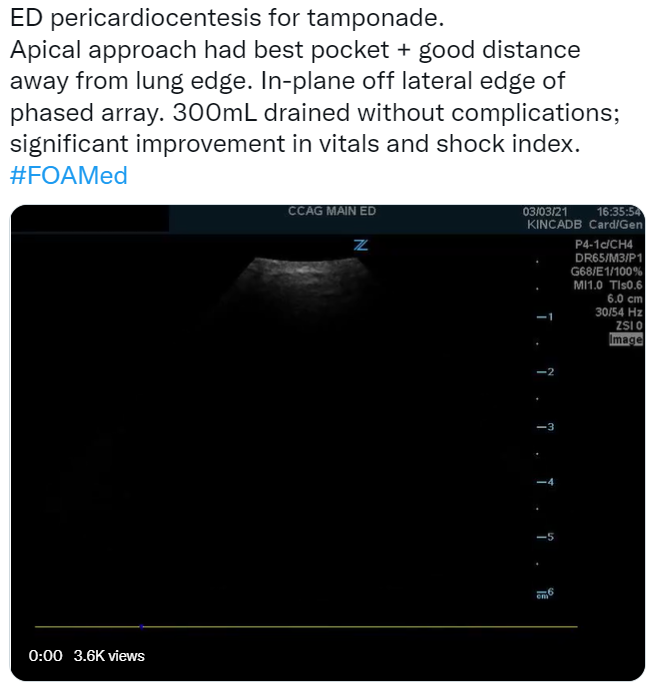 PracticalPOCUS's tweet photo. ED pericardiocentesis for tamponade... let’s take a look!
https://t.co/ROYHpBVsY2
#PracticalPOCUS #POCUS #UltrasoundGEL #podcast @POCUSaurusRex https://t.co/9zkBIDYWr8