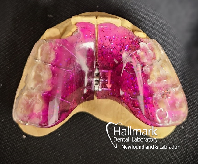 HallmarkLab's tweet image. Can you expand the palate and push those laterals forward?  Oh, and it has to be purple...and sparkle like the stars.  

Shane in St. John's dug deep on the fancy for this one.  I bet this patient was giddy with excitement.  

#expander #customcolours #sparkle