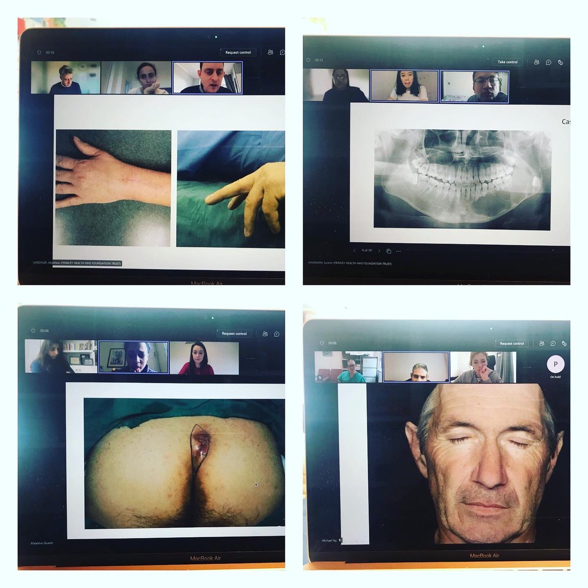 Wexham Plastic Surgery (@wexhamplastic) on Twitter photo Itβs that time of year again π¬ππ½ββοΈππΌββοΈ Our biannual #WexhamFRCSPlast mock exam ran on #msteams for the first time. Thanks to all our wonderful examiners including <a href="/mattdgardiner/">Matthew D. Gardiner</a> <a href="/doc_rostom/">Mai Rostom</a> <a href="/missmplast/">Maleeha Mughal</a> <a href="/SaritaVamadeva/">SaritaVamadeva</a> Itβs that time of year again π¬ππ½ββοΈππΌββοΈ Our biannual #WexhamFRCSPlast mock exam ran on #msteams for the first time. Thanks to all our wonderful examiners including <a href="/mattdgardiner/">Matthew D. Gardiner</a> <a href="/doc_rostom/">Mai Rostom</a> <a href="/missmplast/">Maleeha Mughal</a> <a href="/SaritaVamadeva/">SaritaVamadeva</a>