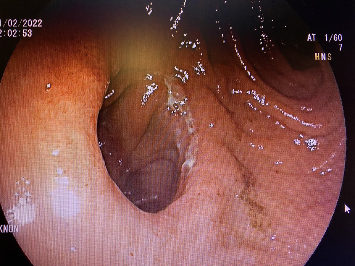 Dr Roman Turro (@romanturro) on Twitter photo After 3 months we can see how nice looks the #anastomosis of the #snap procedure. #future #gettemo #bariatricendoscopy #endoscopia #obesidad #bypass @TerapiasObesid <a href="/EndoscopicTreat/">Endoscopic Treatment</a> <a href="/Clinica_Teknon/">Centro Médico Teknon</a> <a href="/SEEDendoscopia/">SEED</a> <a href="/WindowsGi/">GI Windows Surgical</a> <a href="/aec_obesidad/">AEC-SECO</a> After 3 months we can see how nice looks the #anastomosis of the #snap procedure. #future #gettemo #bariatricendoscopy #endoscopia #obesidad #bypass @TerapiasObesid <a href="/EndoscopicTreat/">Endoscopic Treatment</a> <a href="/Clinica_Teknon/">Centro Médico Teknon</a> <a href="/SEEDendoscopia/">SEED</a> <a href="/WindowsGi/">GI Windows Surgical</a> <a href="/aec_obesidad/">AEC-SECO</a>