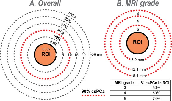 wayne_brisbane's tweet photo. The majority (90%) of #csPCa is within 1 cm of the MRI ROI. Appreciate support from @UclaUrology, @UF_Urology, @jballon92, @jimhumd, @PCFnews, @EUplatinum
https://t.co/k3aeCc1h2S https://t.co/Uar7Wd1vOs