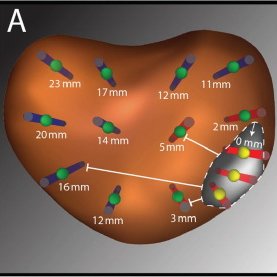 wayne_brisbane's tweet photo. The majority (90%) of #csPCa is within 1 cm of the MRI ROI. Appreciate support from @UclaUrology, @UF_Urology, @jballon92, @jimhumd, @PCFnews, @EUplatinum
https://t.co/k3aeCc1h2S https://t.co/Uar7Wd1vOs