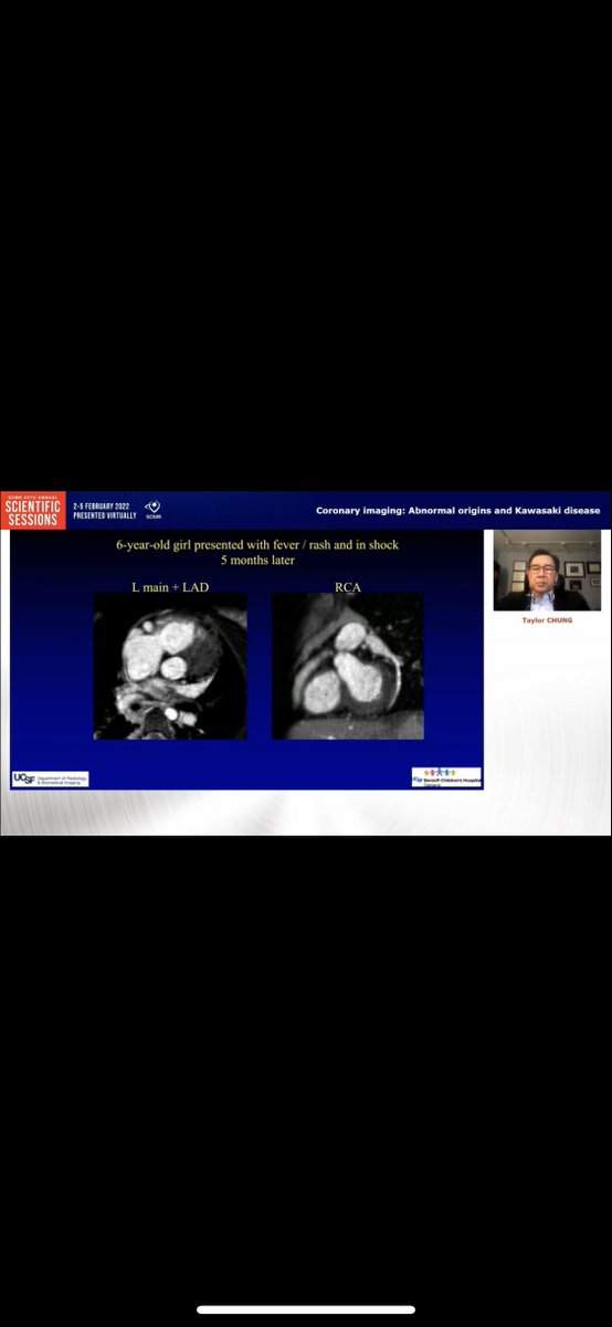 DrJenniferCo_Vu's tweet photo. Interesting #SCMR22 Peds/CHD conference talk by Dr. Taylor Chung on Basic principles in Coronary imaging using #whyCMR  which can be useful in Kawasaki pts with coronary aneurysms and in anomalous coronaries.
@SCMRorg @scmrchd @Scmr3D 
@chiarabd @purviparwani @Kfarooqi https://t.co/tnq6yJYiQs