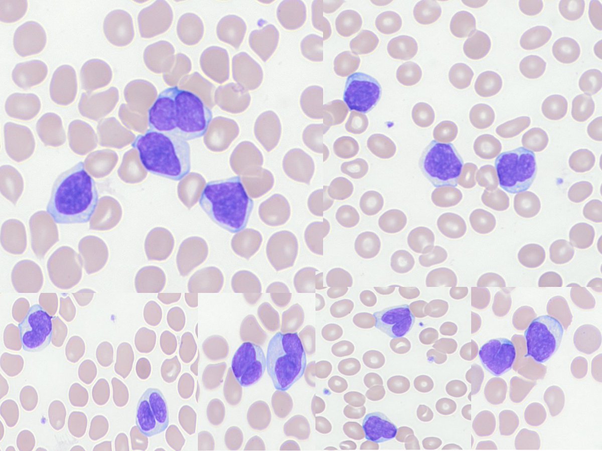 SibaElHussein's tweet photo. B-lymphoma with cleaved cells, think follicular lymphoma or CLL with trisomy 12, pictures below are an example of the latter #hemepath #lymsm #pathtwitter https://t.co/ltlxWzsQ3g