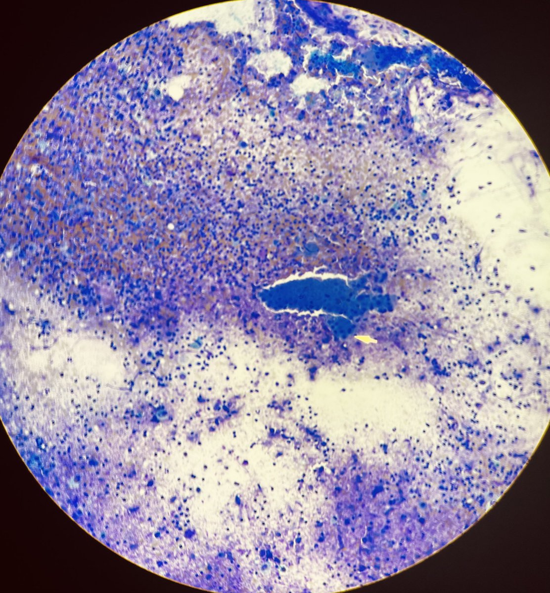 MdMufy's tweet photo. Cystadenoma lymphomatosum papilliferum #warthin tumor #cytopath — I did a touch prep for a nice correlation 😌 https://t.co/wqq2PRZnZ4