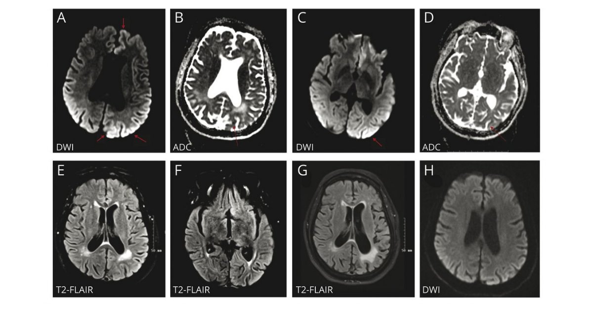 GreenJournal's tweet photo. #NeuroTwitter: test your clinical reasoning with the latest #NeurologyRF Quiz! 👇 https://t.co/YwGoZkY8Tk