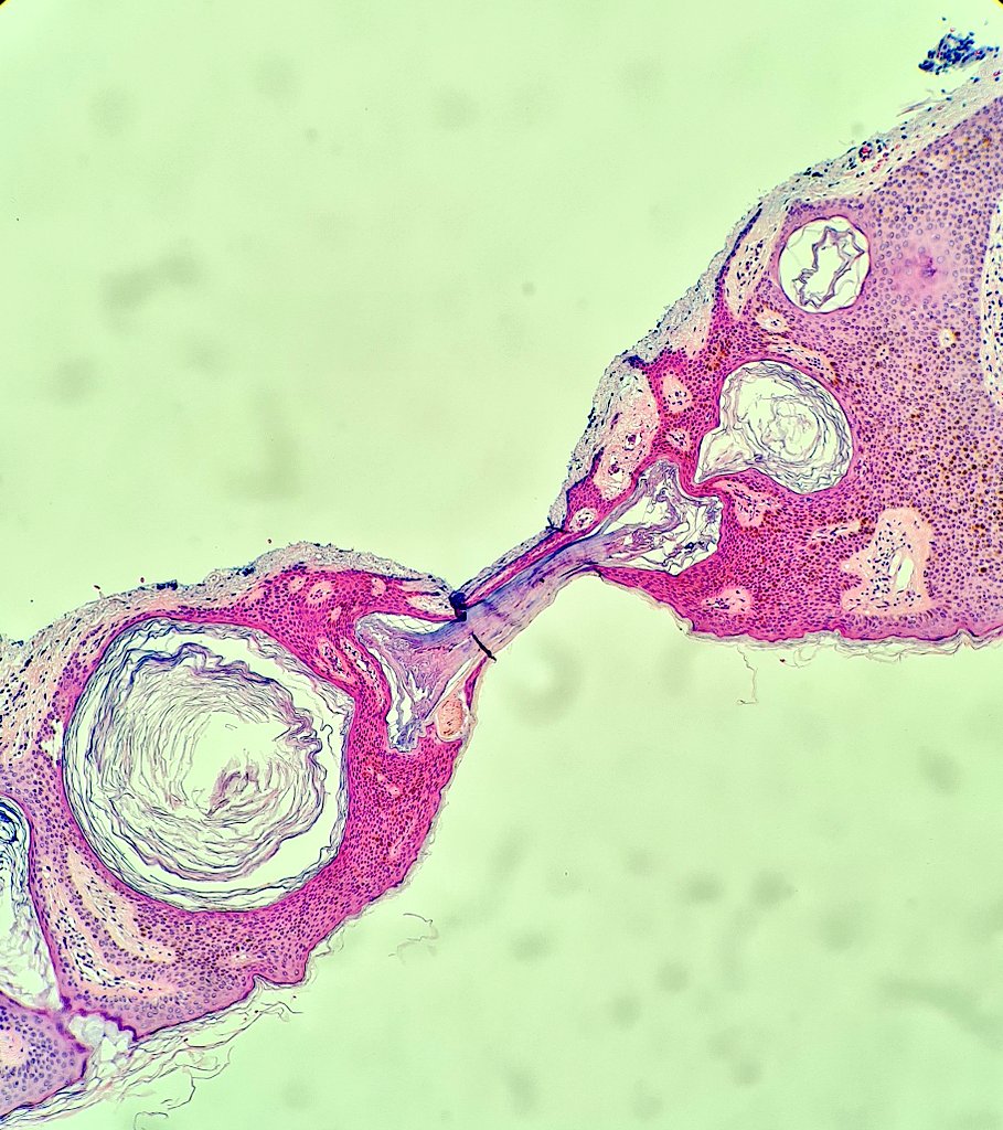 HibTheSlider's tweet image. A keratin pearl of a Seb K being torn apart during processing. 
#pathology #twitterpath #dermpath #pathart