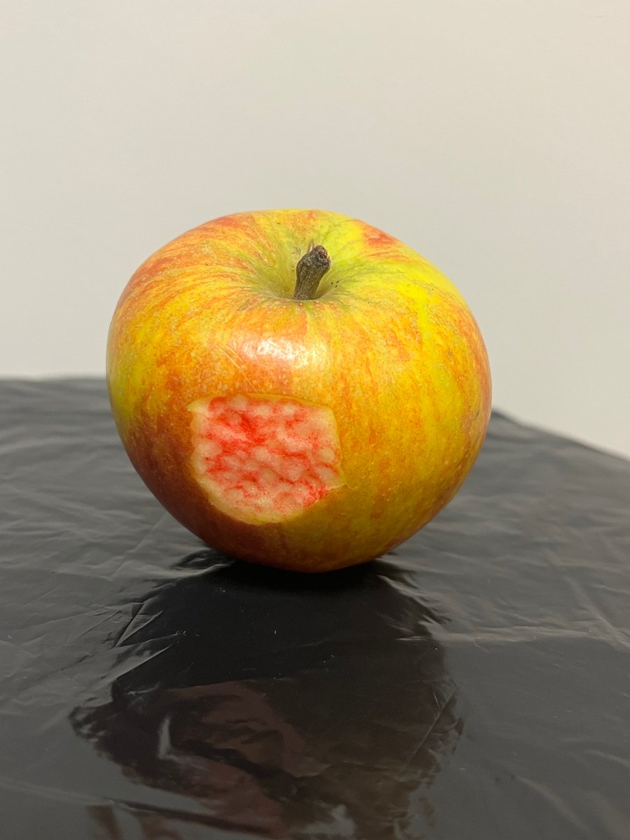 Category 2 Pressure Ulcer- Superficial skin loss with a pink wound bed (may also present as a clear fluid filled blister)
