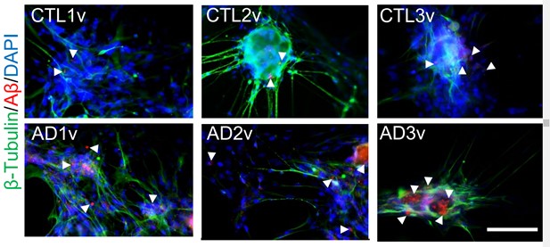 Aguirre1Gustavo's tweet image. Study shows images of SARS CoV2
infecting Neurons
and other cells in the Cerebral Cortex
It shows that Viral Infection
induces the formation of B-Amyloid
and Tau protein
similar to what happens in Alzheimer's
doi.org/10.1101/2022.0…
would be associated with #BioClots
#BioAmyloids