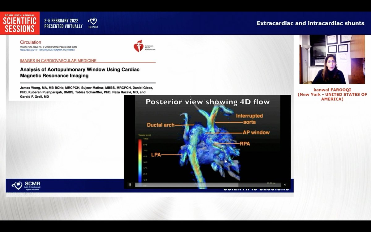 anudodejamd's tweet photo. Terrific talk by @Kfarooqi on #whyCMR for cardiac shunts including beautiful 4D flow imaging @scmrchd @SCMRorg #SCMR22 @PushpaShivaram @DrJenniferCo_Vu @RayRcnita @vineetao17 https://t.co/RJQUTenanA