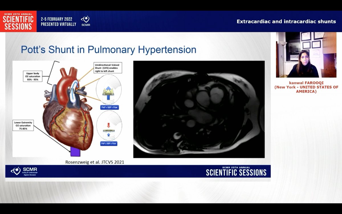 anudodejamd's tweet photo. Terrific talk by @Kfarooqi on #whyCMR for cardiac shunts including beautiful 4D flow imaging @scmrchd @SCMRorg #SCMR22 @PushpaShivaram @DrJenniferCo_Vu @RayRcnita @vineetao17 https://t.co/RJQUTenanA