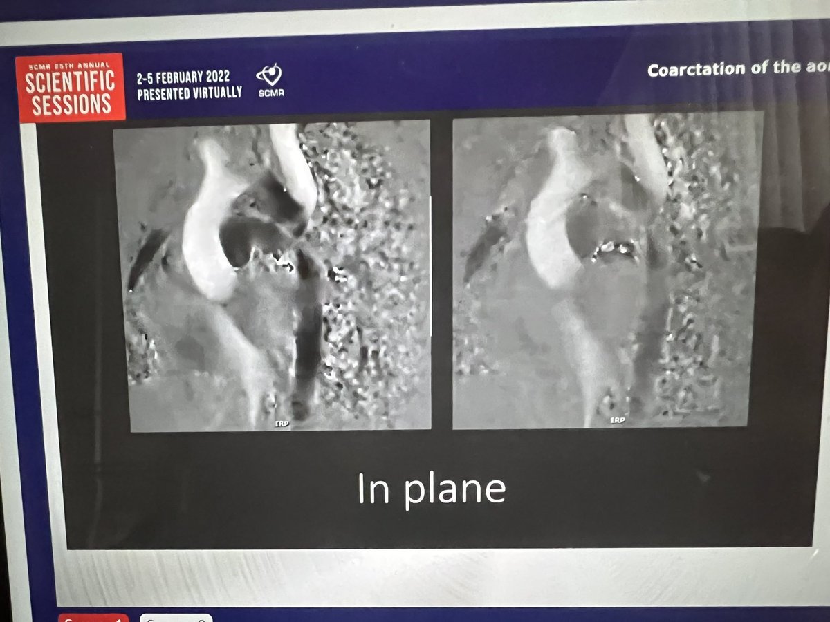 RayRcnita's tweet photo. Beautiful talk on #whyCMR in CoA after repair by Mansi Gaitonde #SCMR22
❤️BB imaging in CoA with stents
❤️In plane and through plane flow
❤️Collateral flow calc
❤️4D flow for aneurysmal dilation 
❤️3D SSFP nav non contrast MRA
❤️Intracranial aneurysms need screening https://t.co/92HPixVSKG