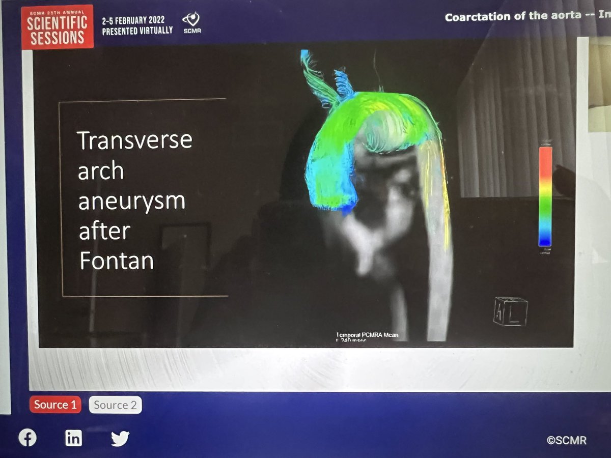 Beautiful talk on #whyCMR in CoA after repair by Mansi Gaitonde #SCMR22
❤️BB imaging in CoA with stents
❤️In plane and through plane flow
❤️Collateral flow calc
❤️4D flow for aneurysmal dilation 
❤️3D SSFP nav non contrast MRA
❤️Intracranial aneurysms need screening