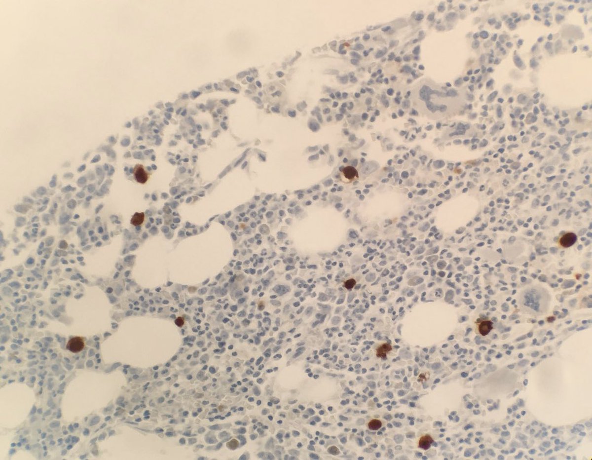Pure red cell aplasia due to parvovirus, with giant pronormoblasts and inclusions. Parvo IHC. #hemepath #pathology #hematology