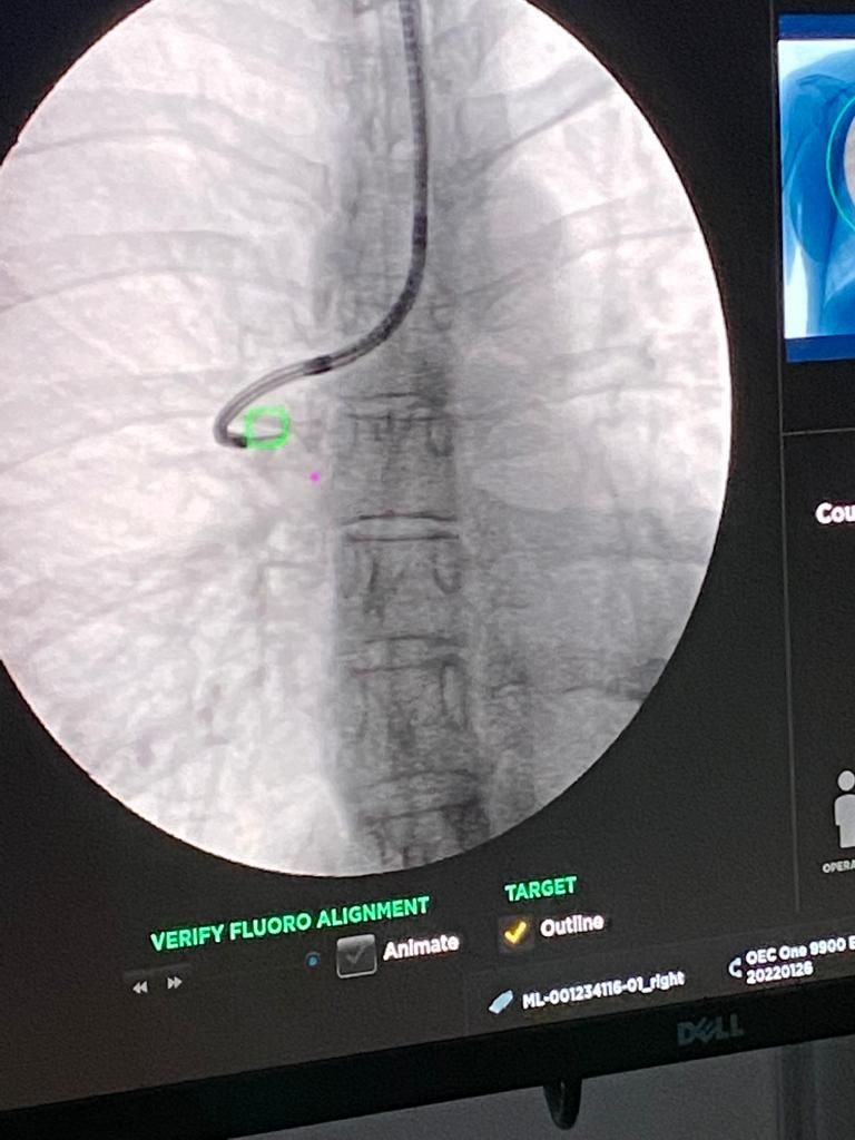 Broncus's tweet photo. Meir Medical Center in Tel Aviv is the first hospital in Israel to introduce Broncus’ Archimedes® Virtual Bronchoscopic Navigation System. We are thrilled to partner with Pr. Shitrit and Dr. Romem in the fight against Lung Disease. #Broncus #LungCancer #Navigation #Pulmonology https://t.co/1QtqZWgPmL