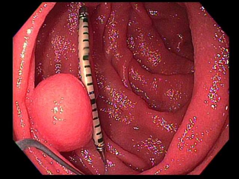 MarkPochapin's tweet photo. The power of measurement!  This is a gangliocytic paraganglioma of the duodenum.  A small endoscopic ruler (called the Napoleon) developed @nyulangone is being used to get an accurate size measurement of 8.5 mm. 
✅Learn more here: https://t.co/5I294uOgJM https://t.co/ZuMTaHvRBU