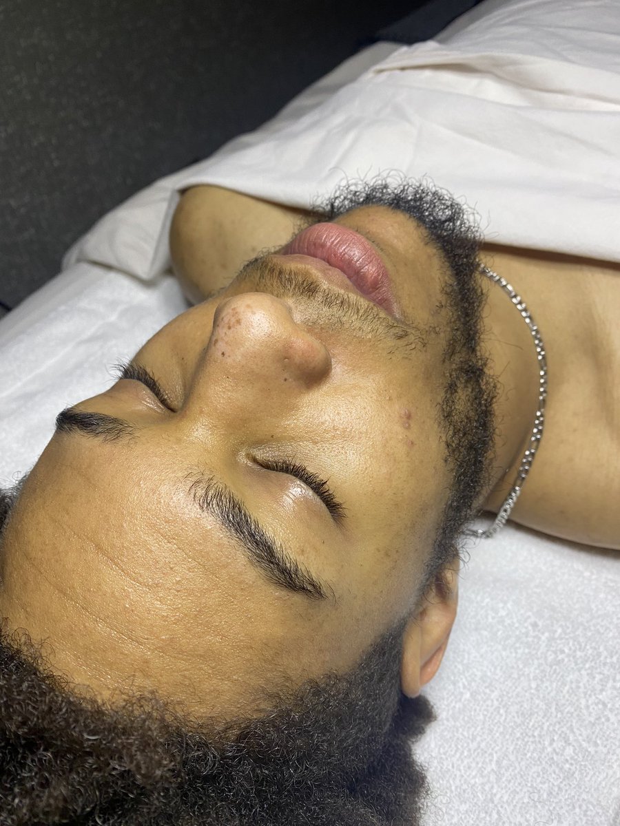 estheticslauri's tweet photo. week 6: before/ after, custom facial! #esthetician #esthetics #rhondaallison #acne #hubby https://t.co/IfKXwON6ir