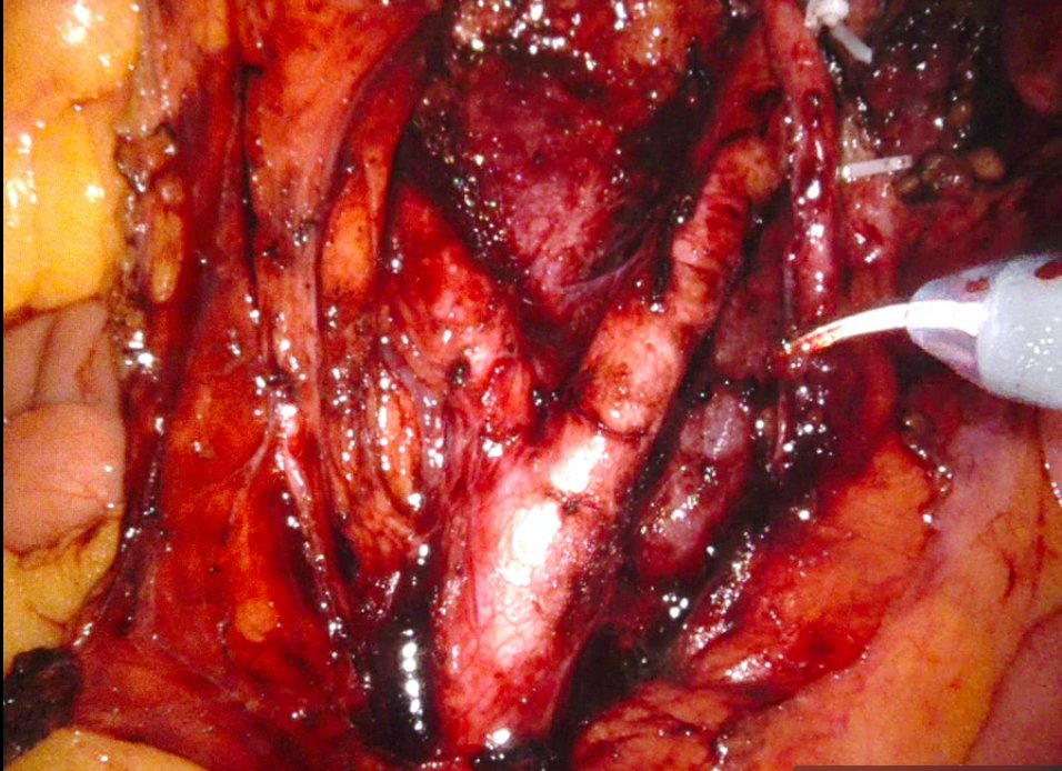 Dr Kanika Batra Modi (@kanicabatra9) on Twitter photo single docking retroperitoneal lymph node dissection in a high-risk cancer endometrium
<a href="/GynaeOncoMICC/">GynaeOnco Max CancerCare</a> <a href="/WinningCancer/">Winning Against Cancer</a> <a href="/MaxHealthcare/">Max Healthcare</a> <a href="/gyncsm/">GYN Cancer | #GYNCSM</a> <a href="/ENYGO_official/">European Network of Young Gynae Oncologists</a> <a href="/IJGConline/">IJGC</a> <a href="/ESGO_society/">ESGO</a> single docking retroperitoneal lymph node dissection in a high-risk cancer endometrium
<a href="/GynaeOncoMICC/">GynaeOnco Max CancerCare</a> <a href="/WinningCancer/">Winning Against Cancer</a> <a href="/MaxHealthcare/">Max Healthcare</a> <a href="/gyncsm/">GYN Cancer | #GYNCSM</a> <a href="/ENYGO_official/">European Network of Young Gynae Oncologists</a> <a href="/IJGConline/">IJGC</a> <a href="/ESGO_society/">ESGO</a>