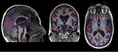 Monash STM Neuroscience (@stmneurosci) on Twitter photo RT - our department @MonashCCS <a href="/Alfred_Research/">Alfred Research Alliance</a> is looking for participants for a study investigating a new drug, sodium selenate, for the treatment of behavioural variant frontotemporal #Dementia For further info pls email - selenate@alfred.org.au or see bit.ly/3Gm8lGj RT - our department @MonashCCS <a href="/Alfred_Research/">Alfred Research Alliance</a> is looking for participants for a study investigating a new drug, sodium selenate, for the treatment of behavioural variant frontotemporal #Dementia For further info pls email - selenate@alfred.org.au or see bit.ly/3Gm8lGj