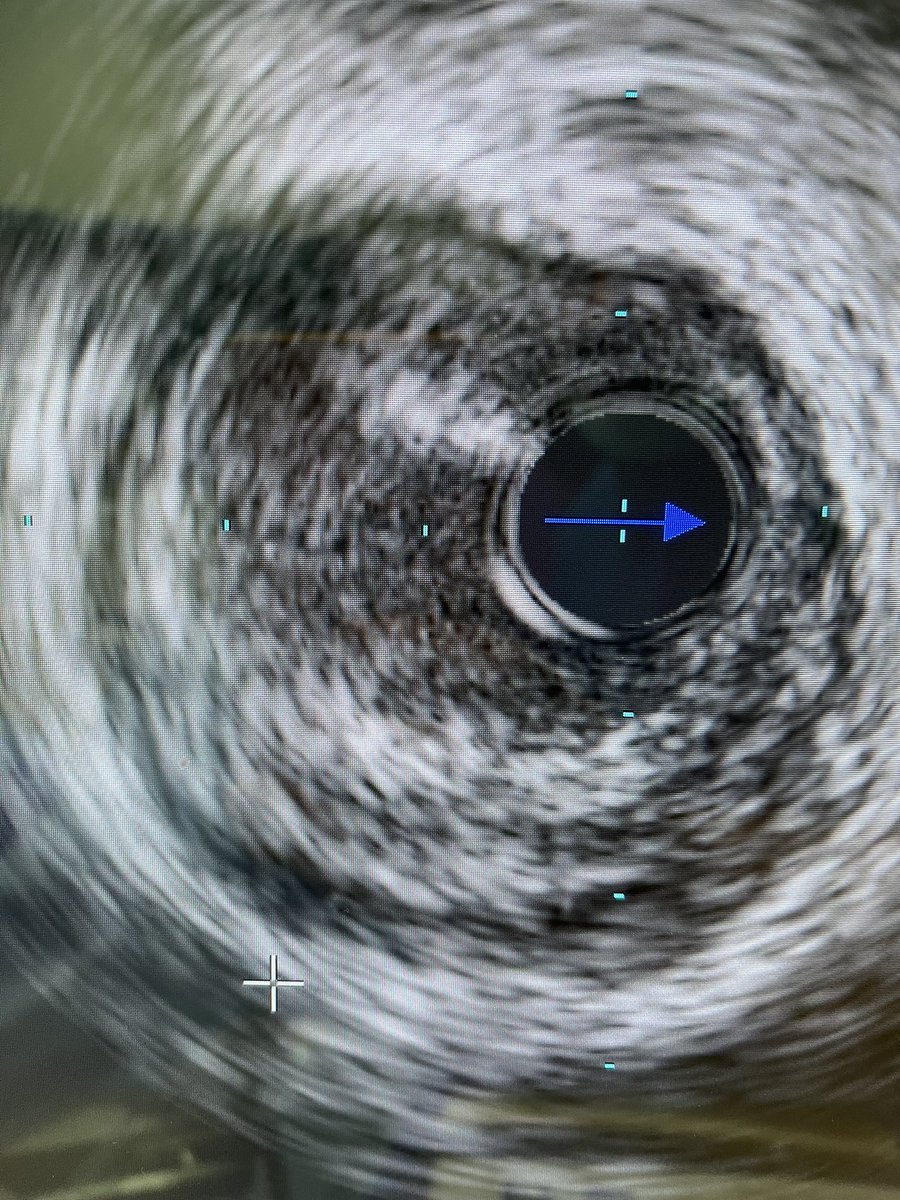 On my latest CTO of LAD 
Tried and used the upgraded #IVUS from volcano <a href="/Philips/">Philips</a> , 45mhrz and auto pullback and useful in co-registration.
The catheter was developed and refined by ASAHi 👏👏