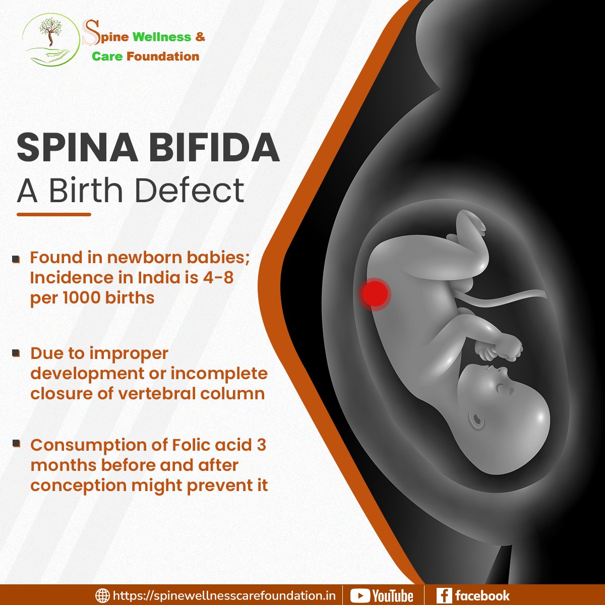 SpineWCF's tweet image. 4/1000 children born in India have spina bifida, a common birth defect that often goes unnoticed due to lack of awareness. This rate in India is 4x that of western countries!
Having Folic Acid can avoid this.

#SWCF #SpinalWellness #SpinalCord #SpinaBifida #birthdefect #awareness